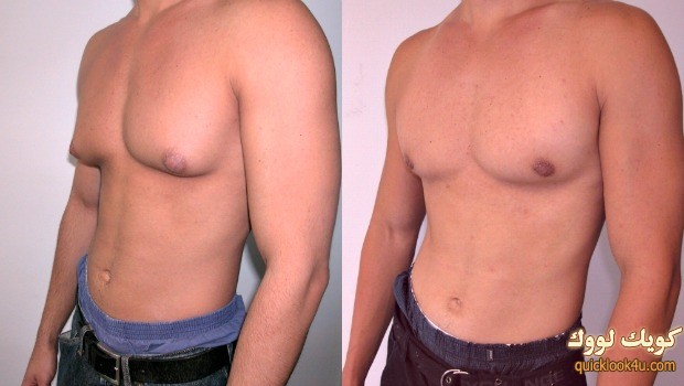نصائح هامة لعلاج ترهل الثدي عند الرجال